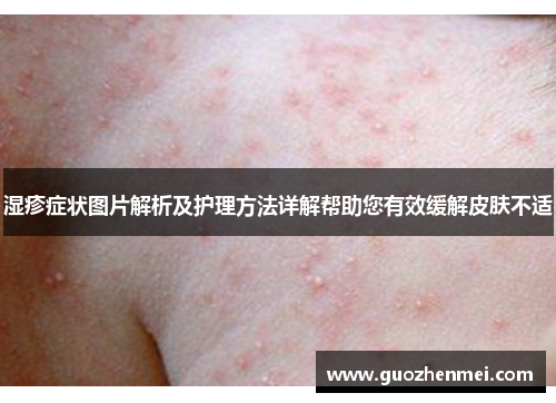 湿疹症状图片解析及护理方法详解帮助您有效缓解皮肤不适